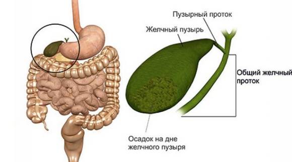 Какие изменения в билиарной системе приводят к билиарному сладжу? Билиарный сладж в желчном пузыре