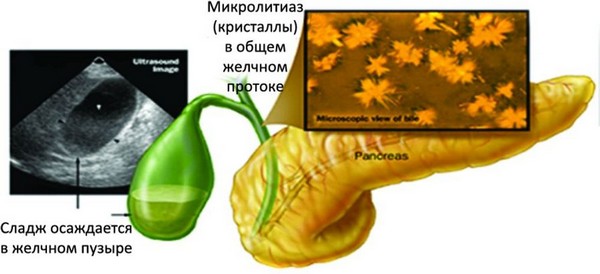 По каким симптомам можно определить взвесь? Взвесь в желчном пузыре
