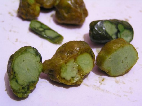 Пигментные или билирубиновые камни Кальцинирование желчных камней