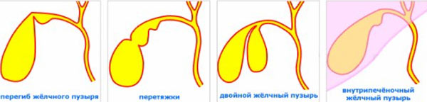 Приобретенная патология Желчный пузырь неправильной формы с перегибом