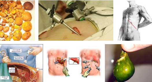 Состояние после удаления желчного пузыря - ПХЭС – синдром Слабость после удаления желчного пузыря