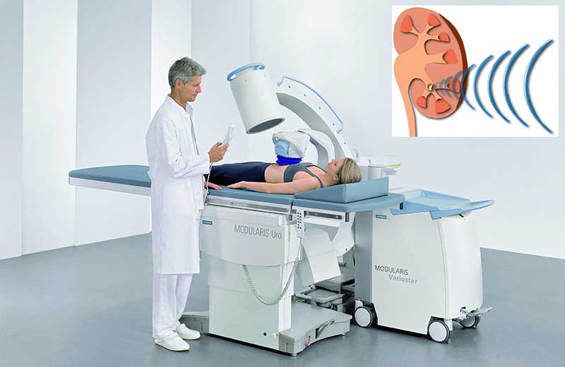 Ударно-волновая экстракорпоральная литотрипсия Калькулезный холецистит