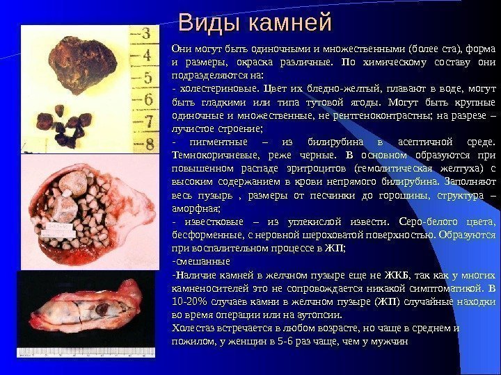 Разновидности камней в желчном пузыре Цвет камней в желчном пузыре