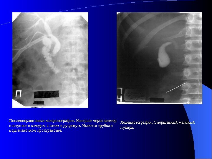 Нефункционирующий желчный пузырь Сморщенный желчный пузырь