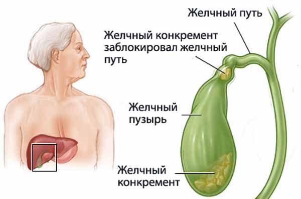 Камни в желчном пузыре, их лечение Камни в желчном пузыре, их лечение
