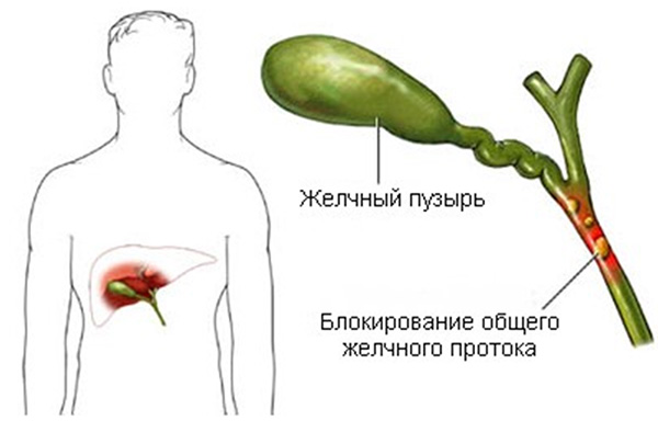 Почему образуется дискинезия? Дискинезия желчного пузыря