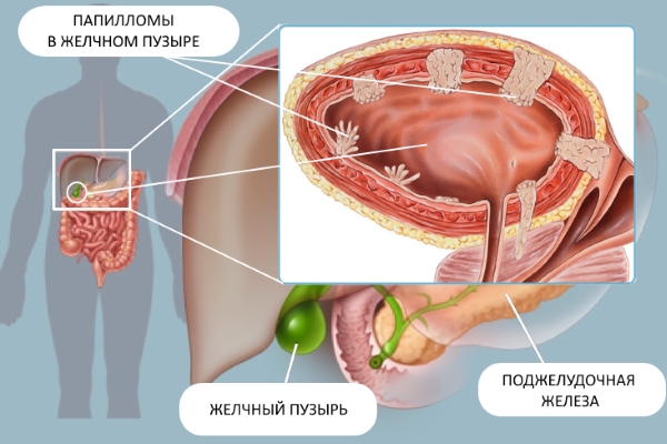 Что такое полипы в желчном пузыре? Бессмертник при полипах желчного пузыря