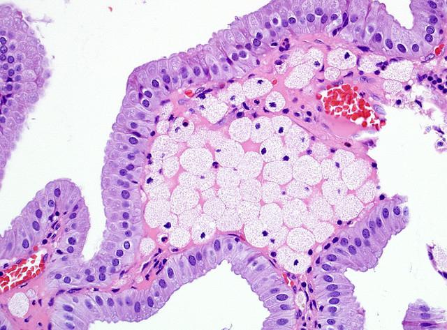 Холестероз желчного пузыря Почему удаляют желчный пузырь?
