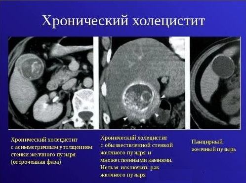 Хроническая форма холецистита Симптомы воспаления желчного пузыря у женщин