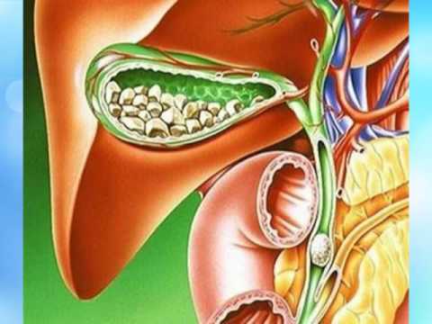 Причины недугов желчного пузыря – в том числе камни в желчном пузыре Как уменьшить желчный пузырь?