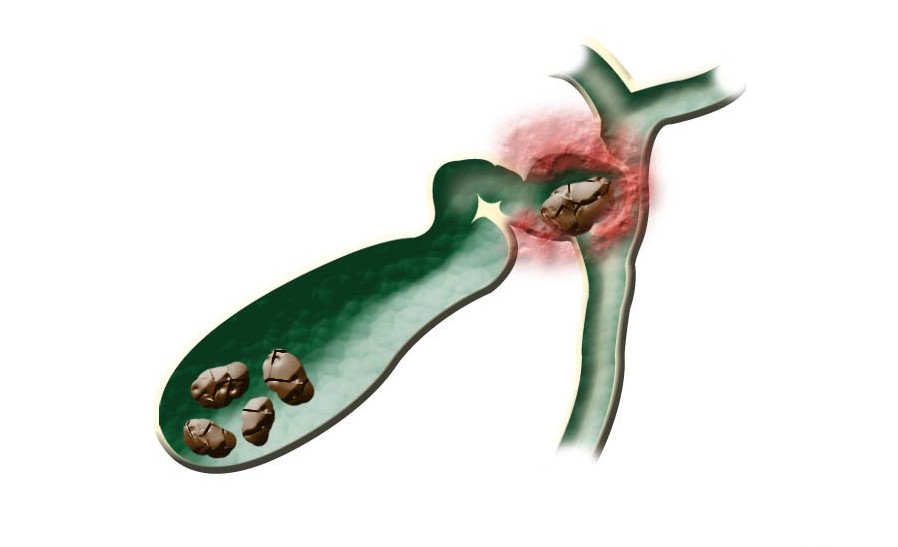 Удаление желчного пузыря Чеснок после удаления желчного пузыря