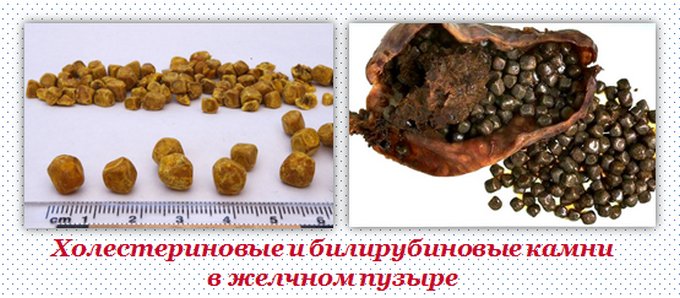 Симптоматика болезни холелитиаз Цвет камней в желчном пузыре