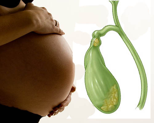 Патологии желчного пузыря при беременности Лапароскопия желчного пузыря при беременности