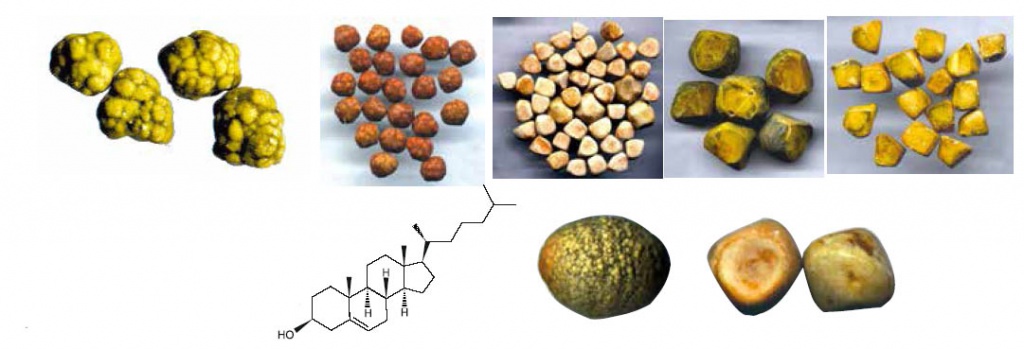 Воспаление желчного пузыря Камни в желчном пузыре у пожилого человека