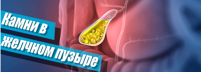 Народная медицина для лечения камней в желчном пузыре Пол-пала от камней в желчном пузыре