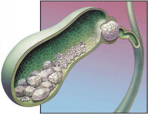 Почему возникают камни в желчных протоках? Желчный камень в протоке