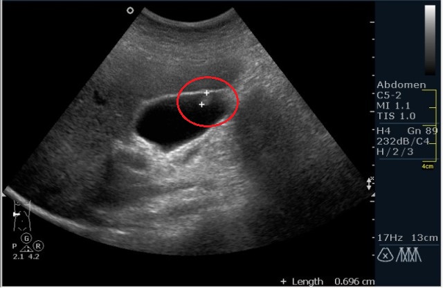 Как лечить полипы желчного пузыря? Полип в желчном у ребёнка