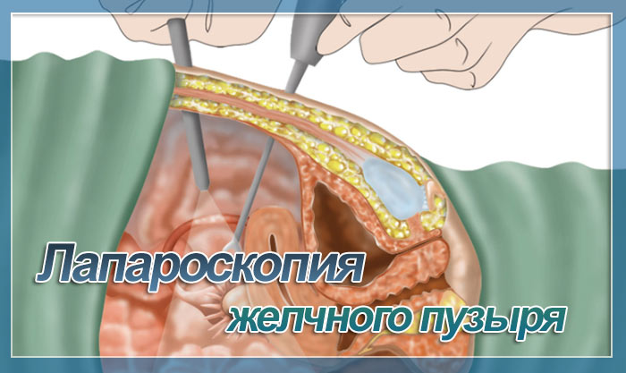 Как готовиться к лапароскопии? Где сделать операцию по удалению желчного пузыря?