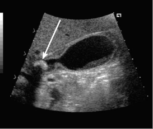 Симптомы камней в желчном пузыре Симптомы камней в желчном пузыре