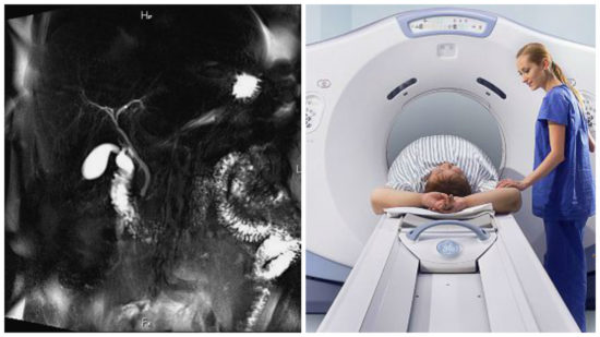 МРТ исследование желчного пузыря МРТ желчного пузыря