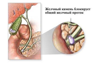 Как распознать обтурацию холедоха? Камень в шейке желчного пузыря. Что делать