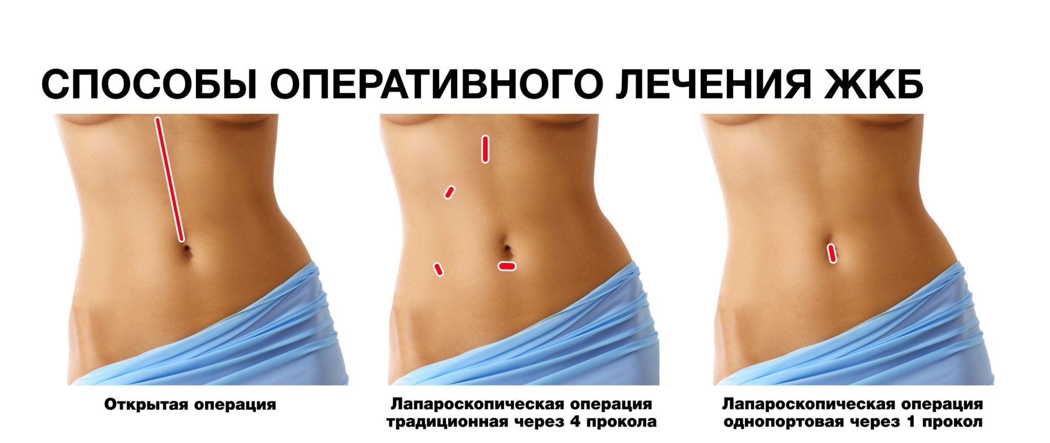 Сколько по времени идет холецистэктомия? Сколько длится операция по удалению желчного пузыря?