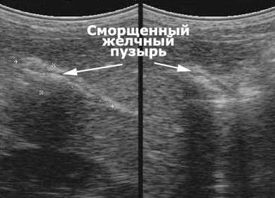 Лечение патологии сморщенный желчный пузырь Сморщенный желчный пузырь