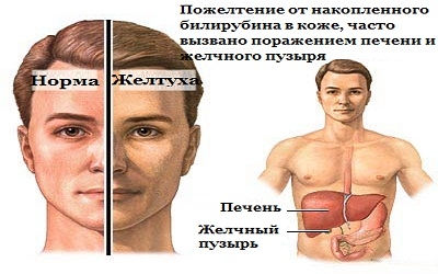 Некоторые недуги печени и лечение травами Травы для печени и желчного пузыря