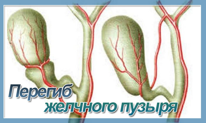 Почему образуется перегиб? Желчный пузырь неправильной формы с перегибом