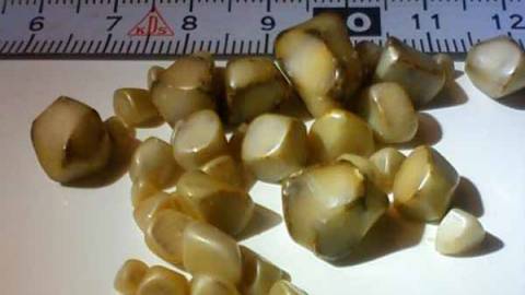 Почему образуются камни в желчном пузыре? Крупные камни в желчном пузыре