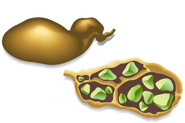 Голодание в лечении желчных камней Голодание при желчекаменной болезни