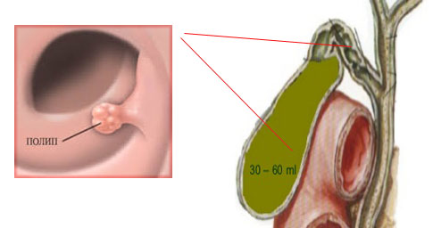 Лечение полипов в желчном пузыре Полынь полипы желчный пузырь