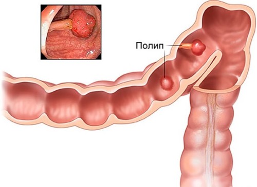 Локальное утолщение стенки Маленький желчный пузырь