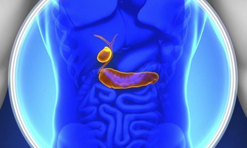 Почему образуются полипы? Кальцинированный полип желчного пузыря