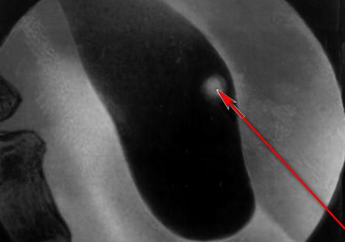 Противопоказания к применению отвара полыни Полынь полипы желчный пузырь