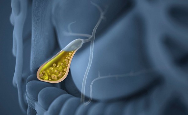 Наиболее распространенные причины образования желчных конкрементов Кальцинирование желчных камней