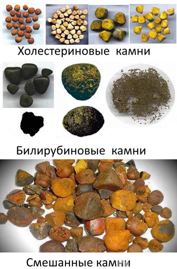 Причины камнеобразования в этом внутреннем органе Пошли камни из желчного пузыря. Что делать?
