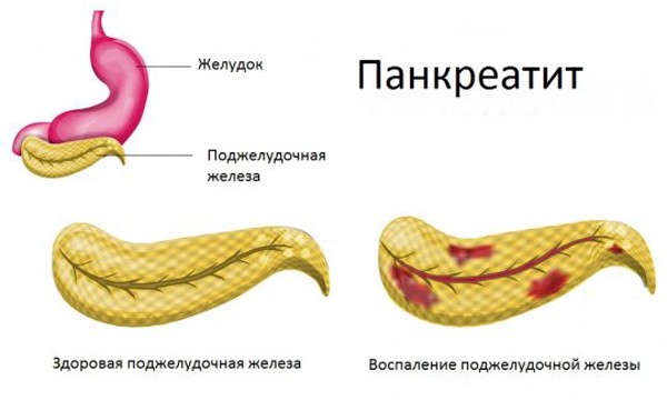 Почему возникает механическая желтуха? Желтуха после удаления желчного пузыря