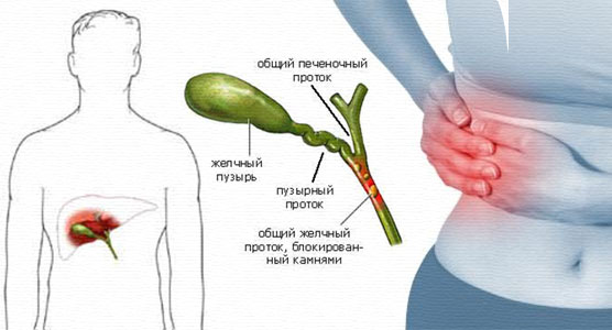 Бывают ли рецидивы? Желчный камень в протоке