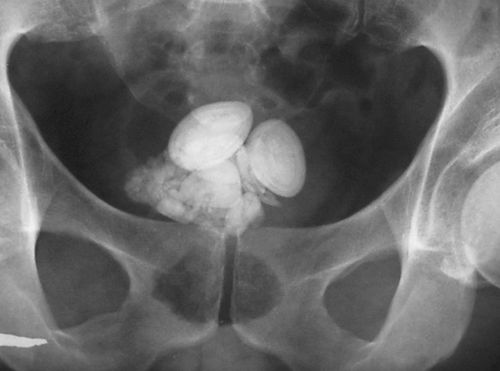 Обзорная рентгенография мочевого пузыря Камни желчного пузыря с другим холециститом