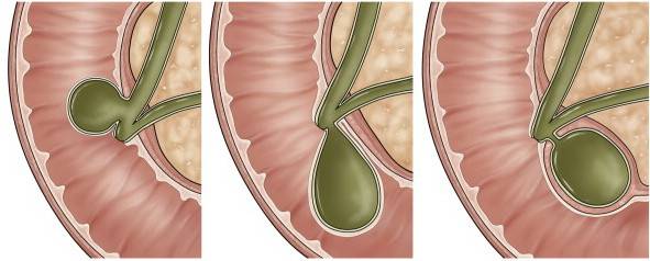 Почему возникают деформации желчного пузыря? S-образная форма желчного пузыря