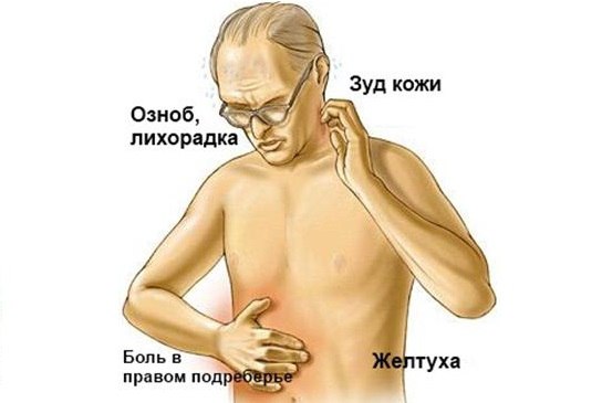 Симптомы острого холецистита Воспаление желчного пузыря