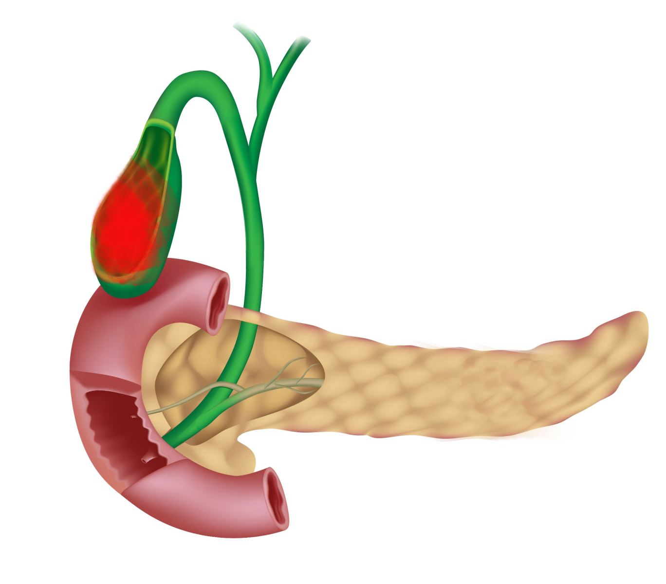 Симптомы воспаления желчного пузыря Симптомы воспаления желчного пузыря