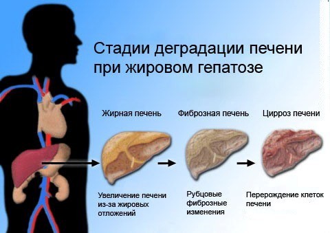 Стадии деградации печени Гепатоз желчного пузыря