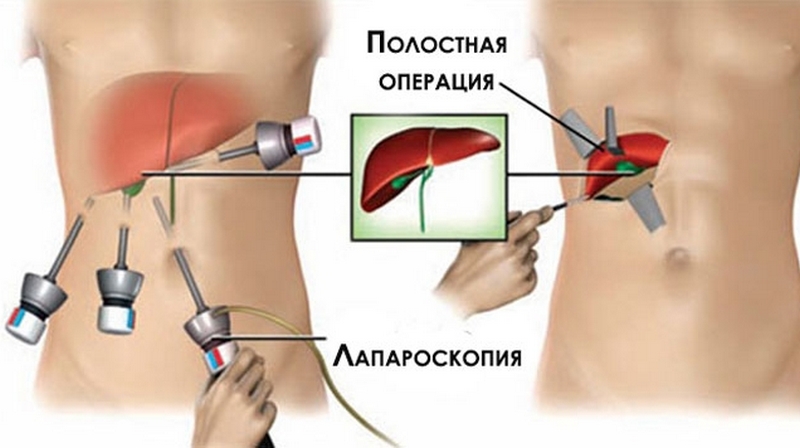 Лапароскопия желчного пузыря Восстановление после удаления желчного пузыря