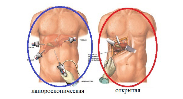 Осложнения после лапаротомии Бандаж после удаления желчного пузыря