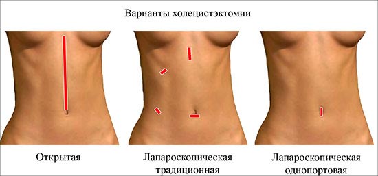 Когда назначается лапароскопия желчного? Шов после лапароскопии желчного пузыря