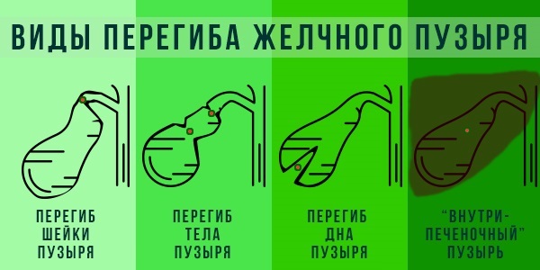 Разновидности этой патологии Перегиб желчного пузыря