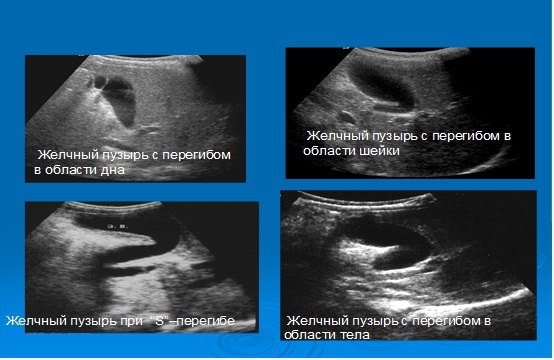 Диагностика перегиба желчного пузыря Перегиб желчного пузыря