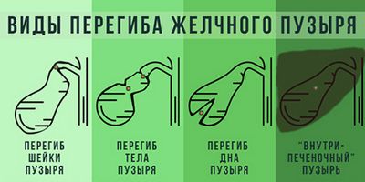 Аномалии форм желчного пузыря Желчный пузырь грушевидной формы